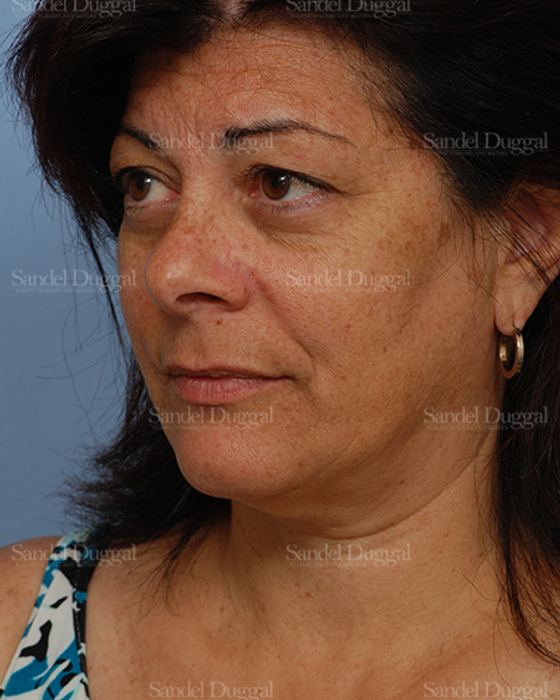 Facelift before, case 2671