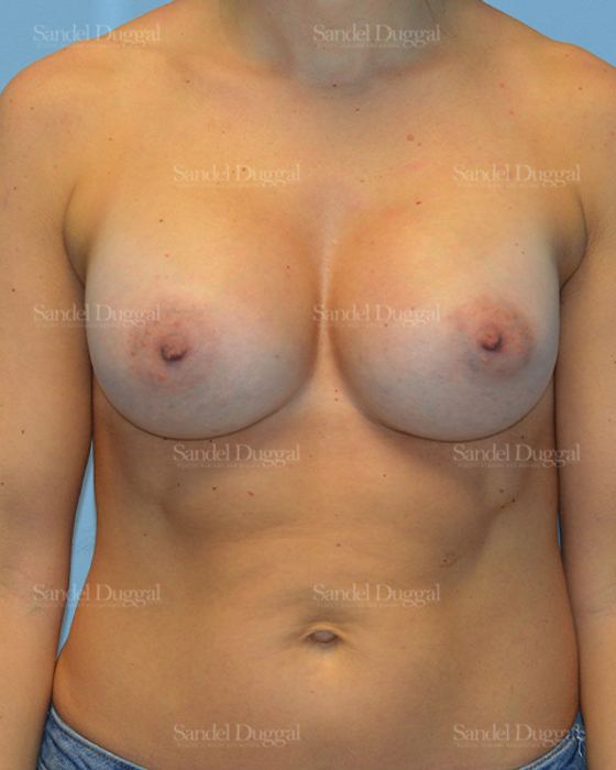 Breast Augmentation after, case 3157