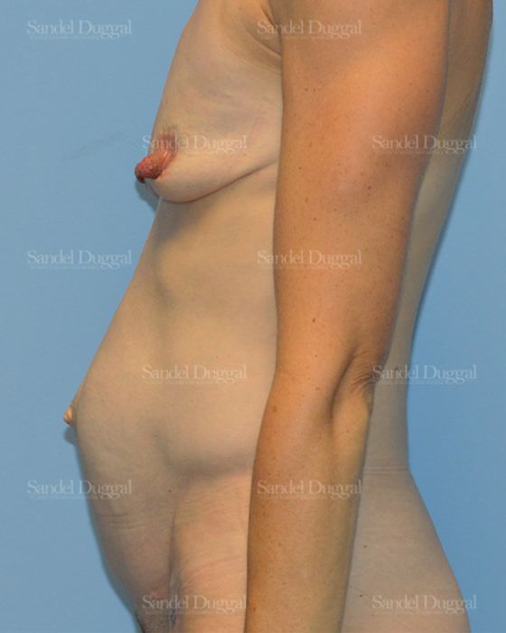 Tummy Tuck before, case 1622
