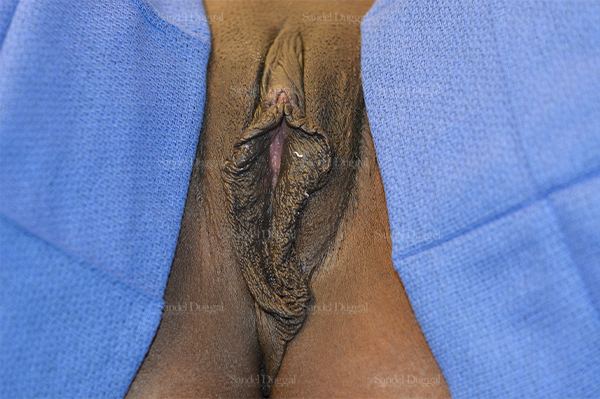 Labiaplasty before, case 3054