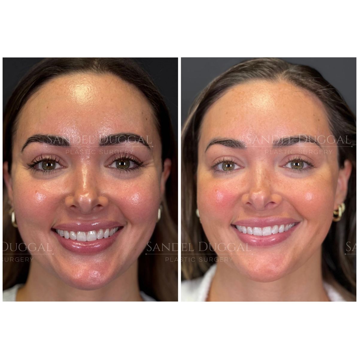 Botox & Fillers before and after, case 6007