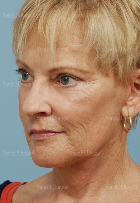 Laser Skin Resurfacing after, case 2692