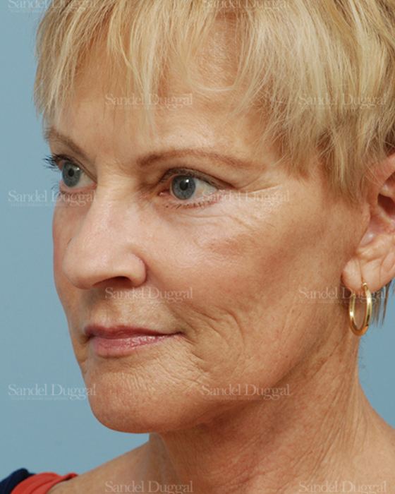 Laser Skin Resurfacing after, case 2692