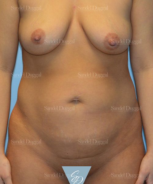 Tummy Tuck before, case 1680