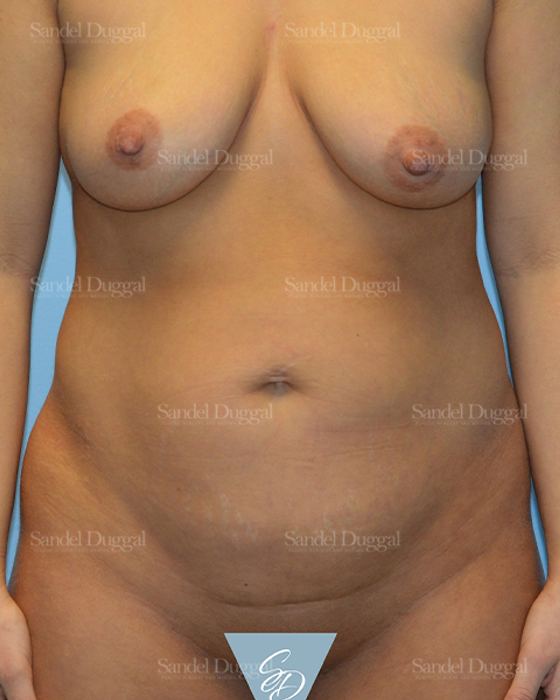 Tummy Tuck before, case 1680