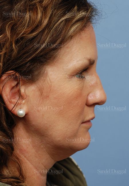 Facelift before, case 2685