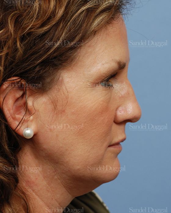 Facelift before, case 2685