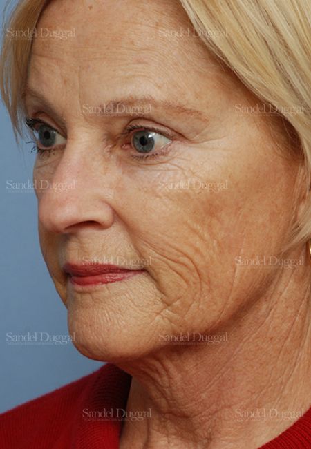Laser Skin Resurfacing before, case 2958