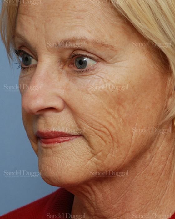 Laser Skin Resurfacing before, case 2958