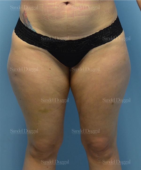Liposuction — Legs & Flanks before, case 2532
