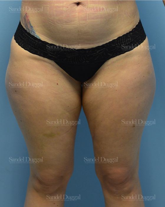 Liposuction — Legs & Flanks before, case 2532