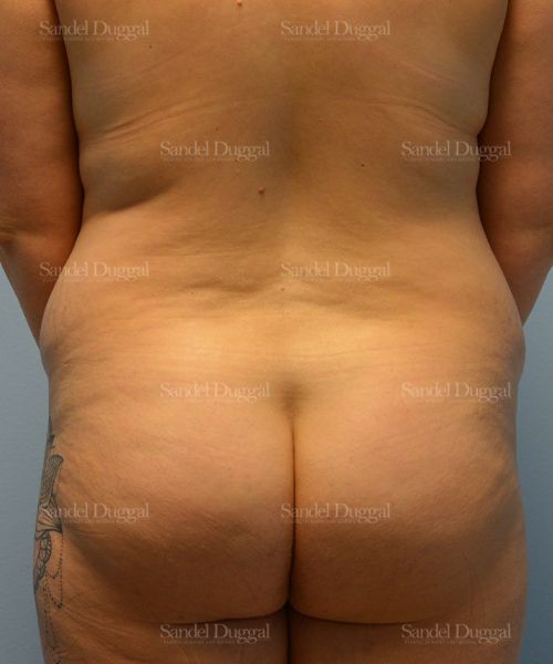 Liposuction — Legs & Flanks before, case 2515