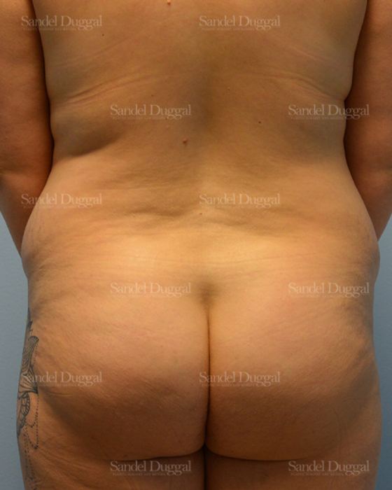Liposuction — Legs & Flanks before, case 2515