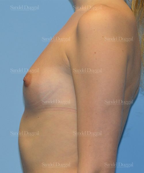 Breast Augmentation before, case 3080