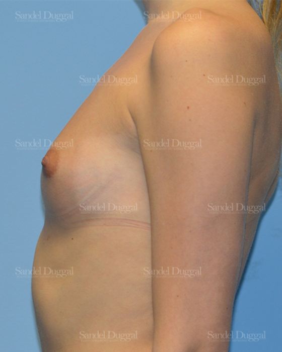 Breast Augmentation before, case 3080