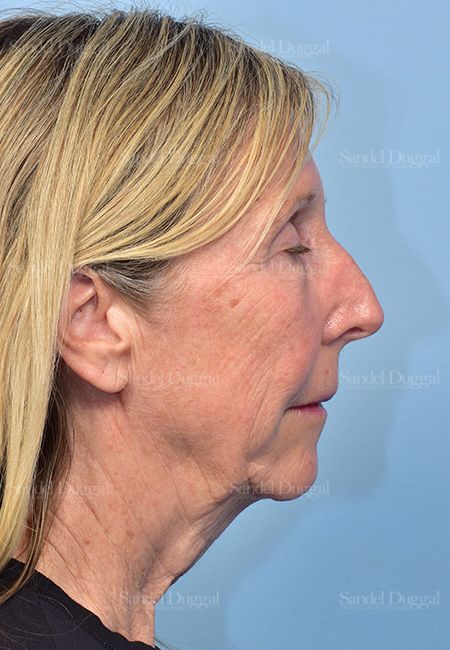 Facelift before, case 5735