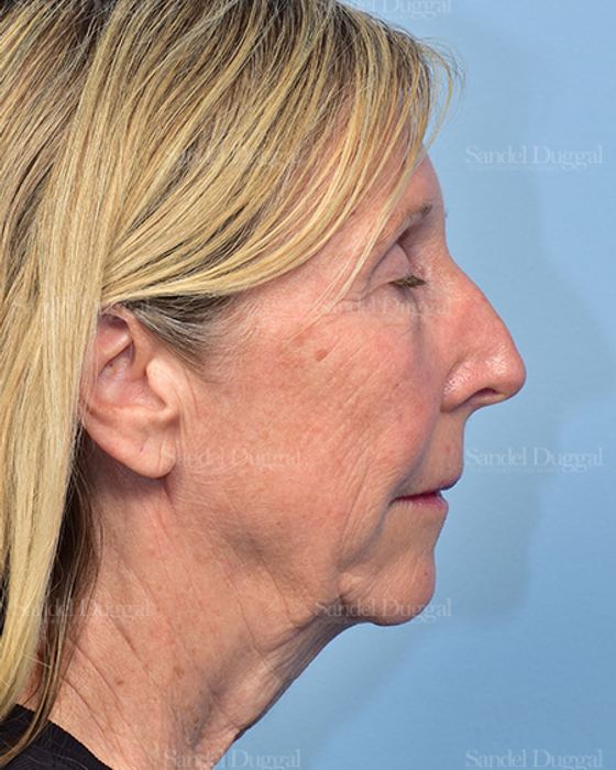 Facelift before, case 5735