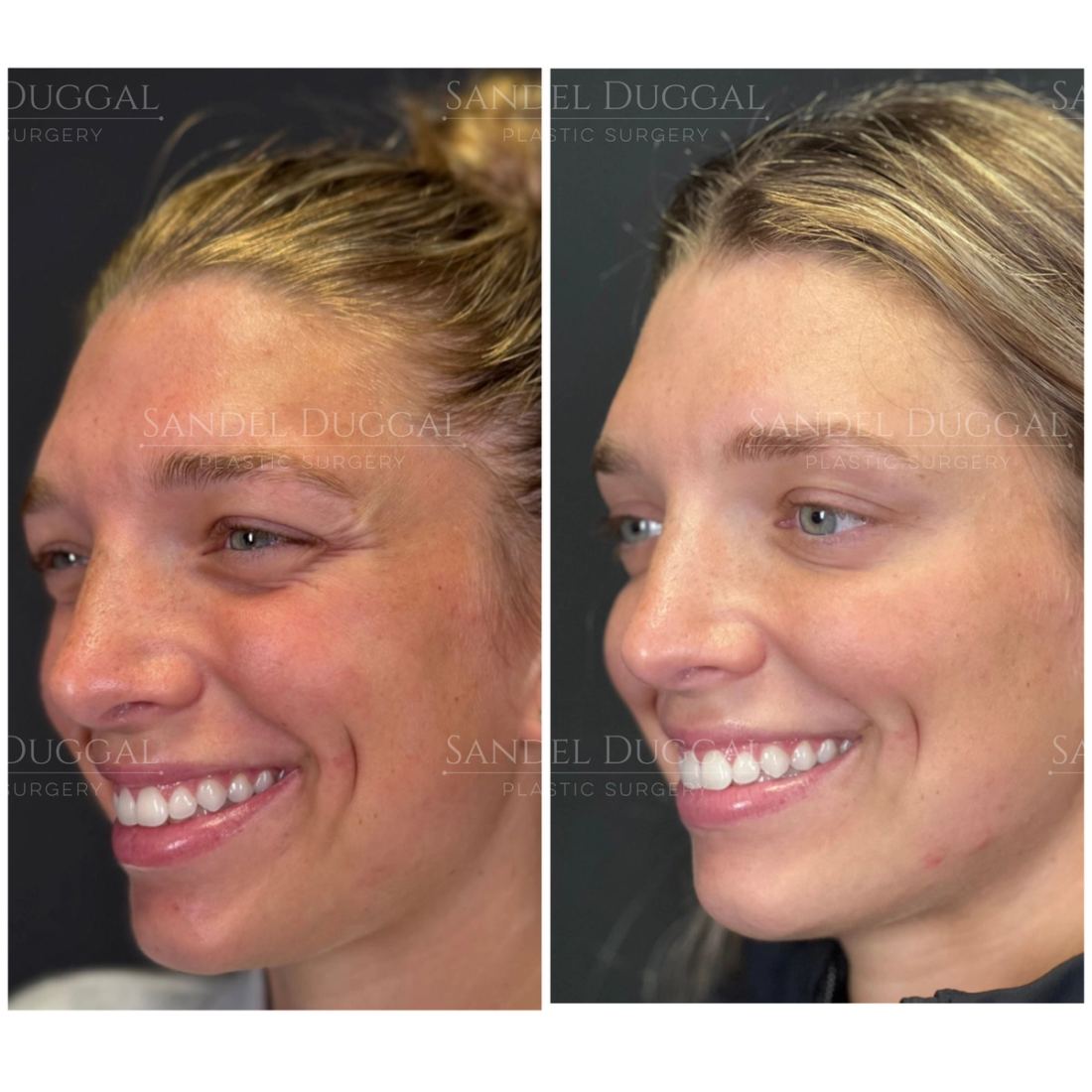 Botox & Fillers before and after, case 6009