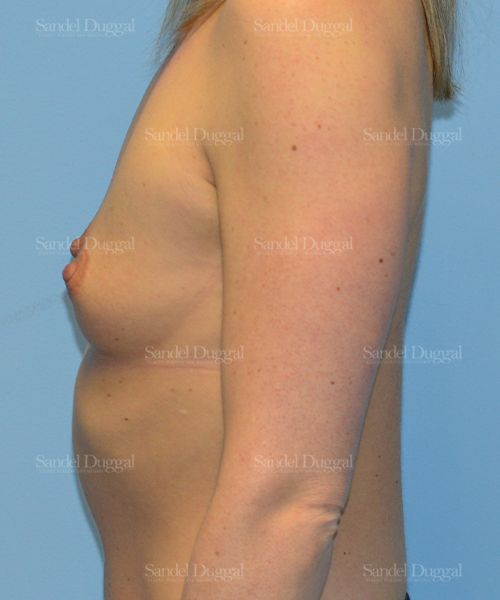 Breast Augmentation before, case 3171