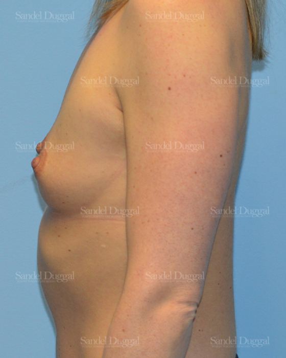 Breast Augmentation before, case 3171