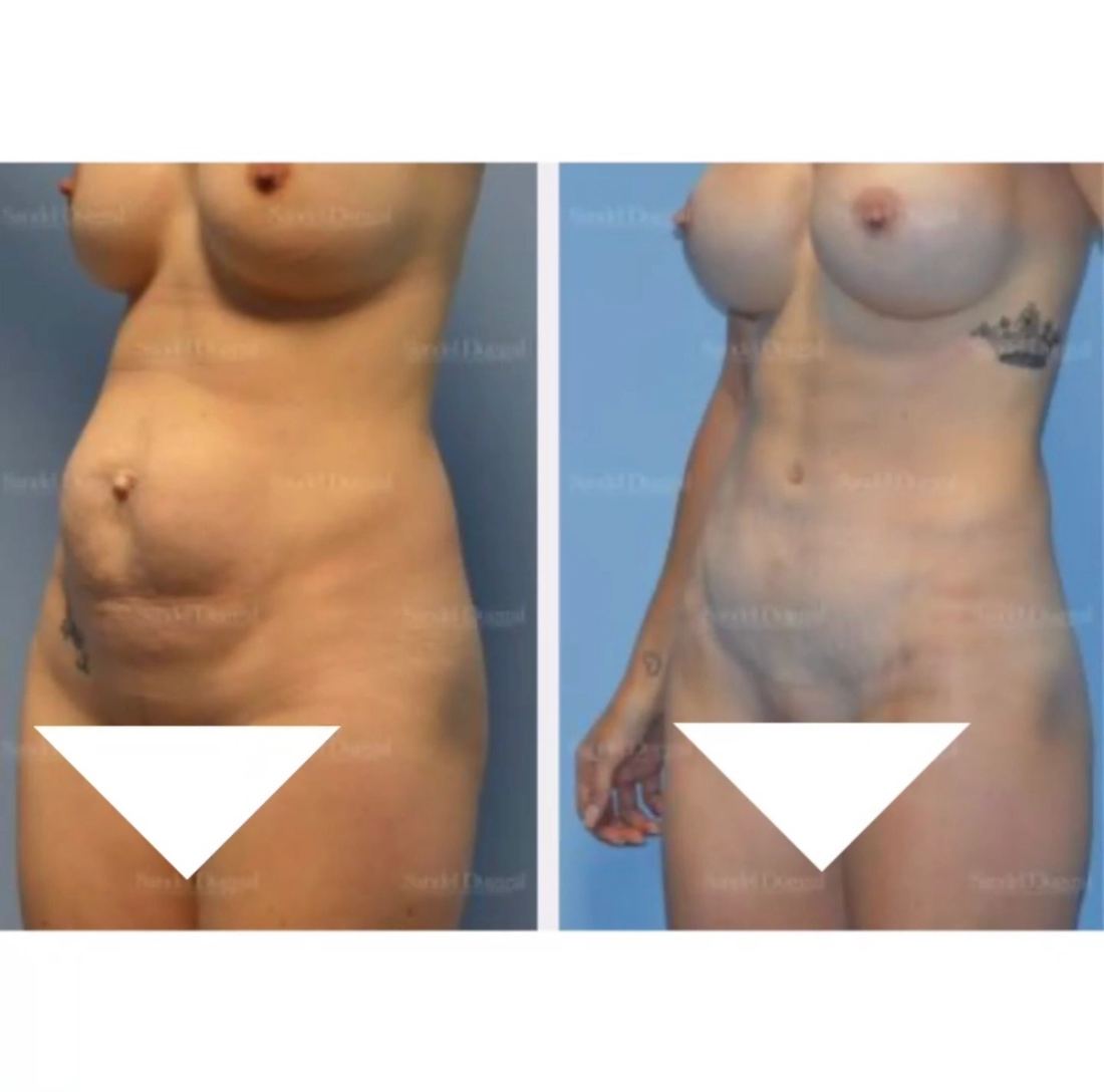 Mommy Makeover before and after, case mommy-makeover-12