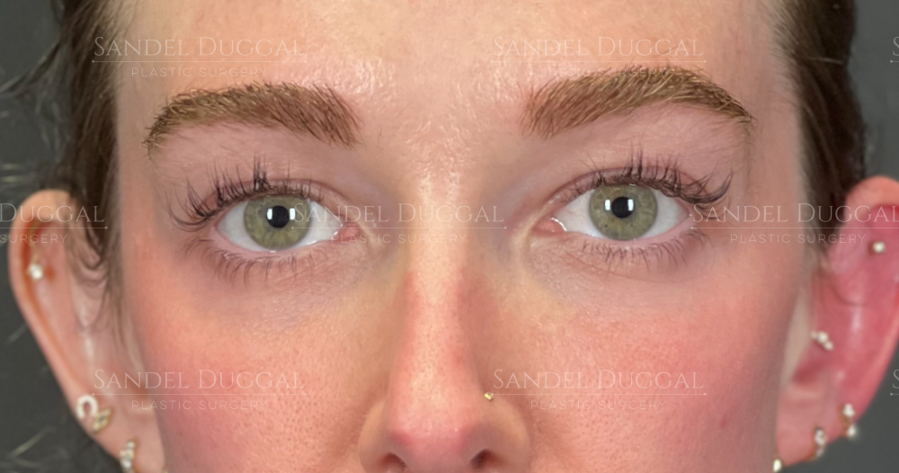 Eyelid Rejuvenation before, case 6001