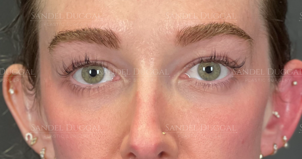 Eyelid Rejuvenation before, case 6001