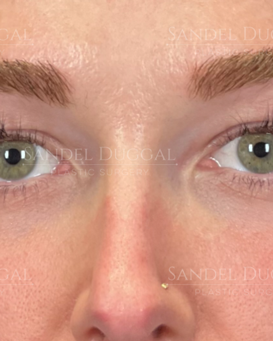 Eyelid Rejuvenation before, case 6001