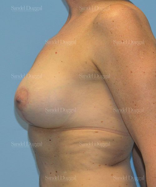 Breast Augmentation with Lift after, case 3414
