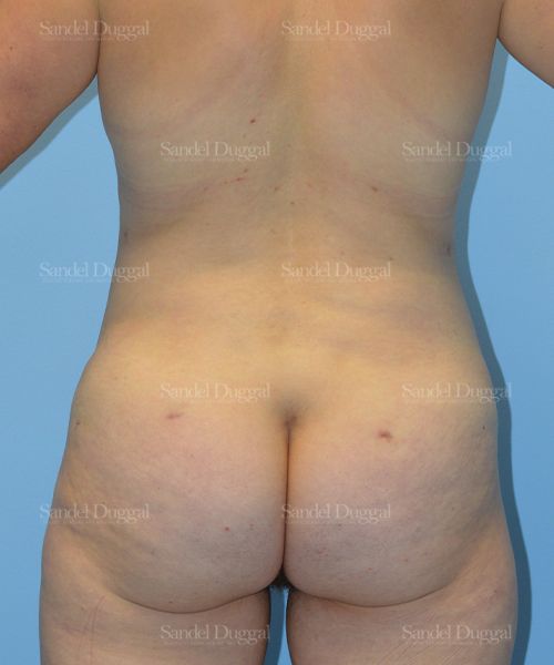 Tummy Tuck after, case 1643