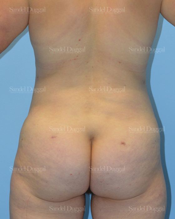 Tummy Tuck after, case 1643