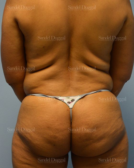 Tummy Tuck before, case 1510