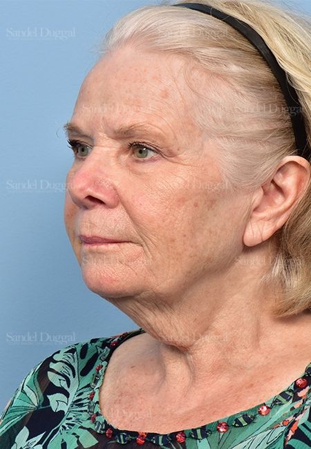 Facelift before, case 5337