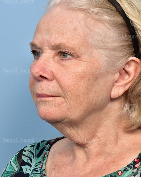 Facelift before, case 5337