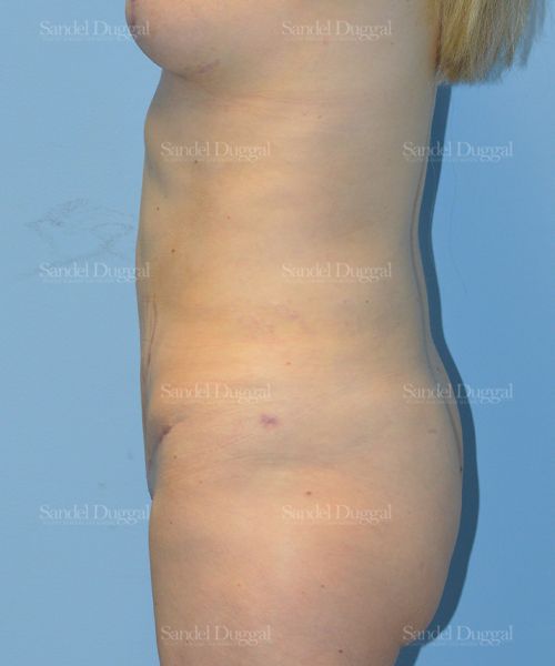 Tummy Tuck after, case 1659