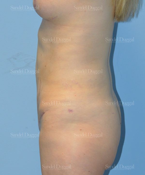 Tummy Tuck after, case 1659