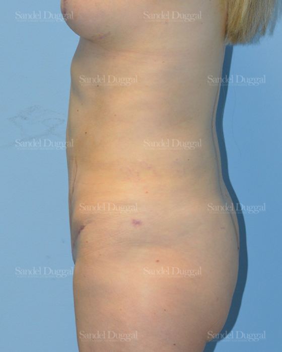 Tummy Tuck after, case 1659