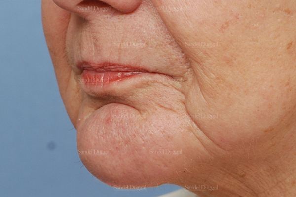 Chin Augmentation after, case 1487
