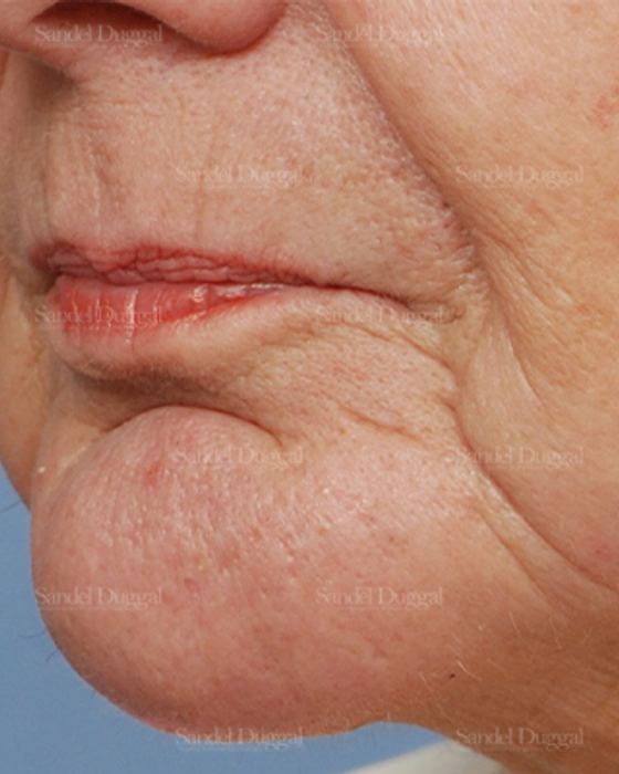 Chin Augmentation after, case 1487