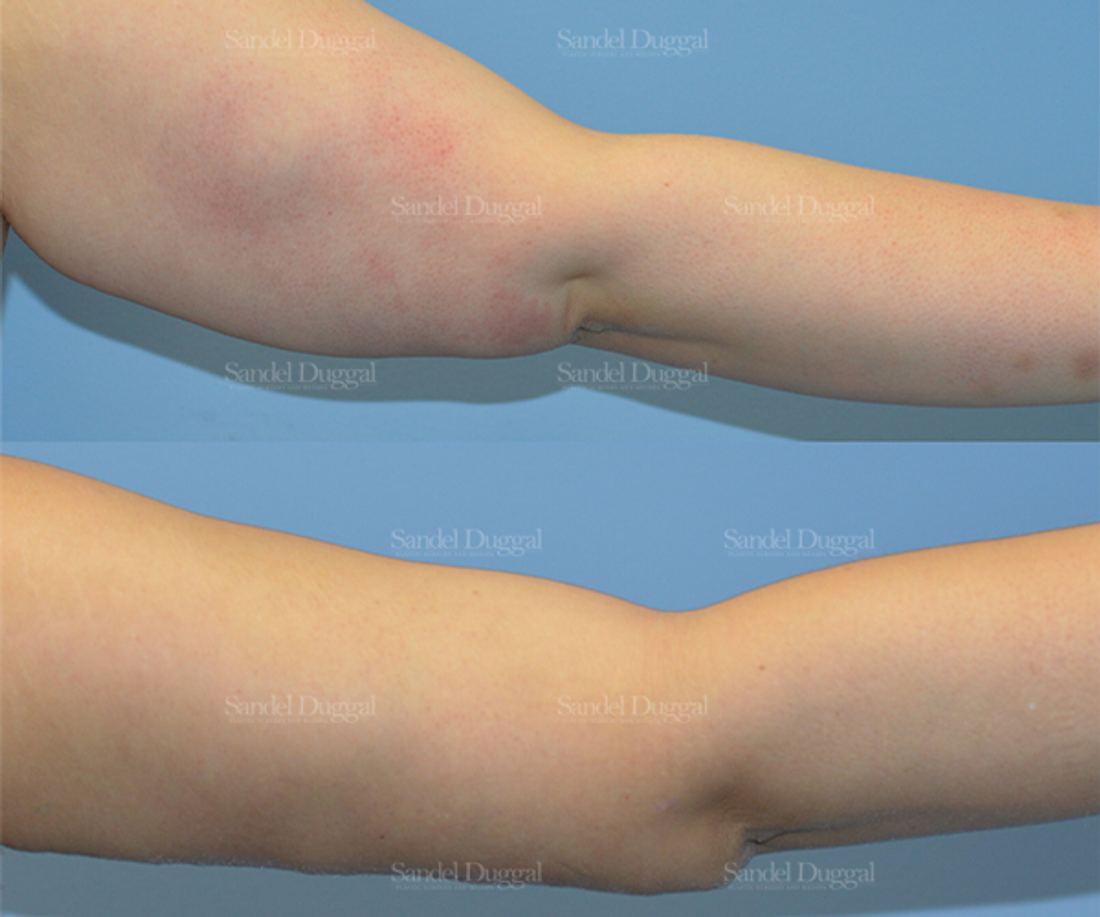 Brachioplasty before and after, case 2129