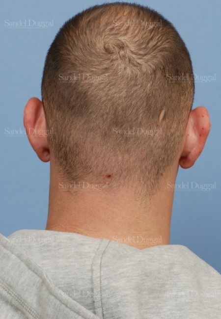 Otoplasty before, case 4068
