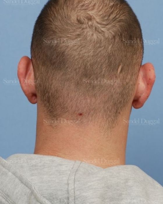 Otoplasty before, case 4068