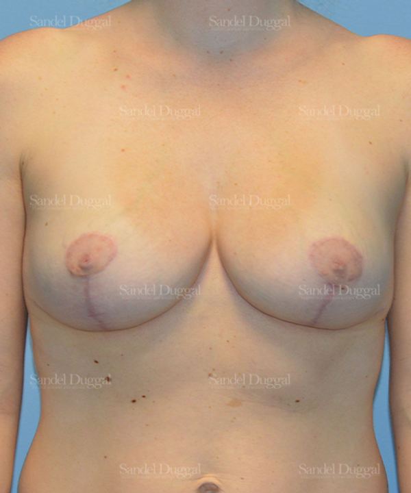 Breast Augmentation with Lift after, case 3428