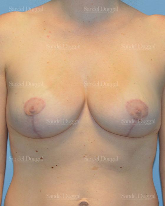Breast Augmentation with Lift after, case 3428