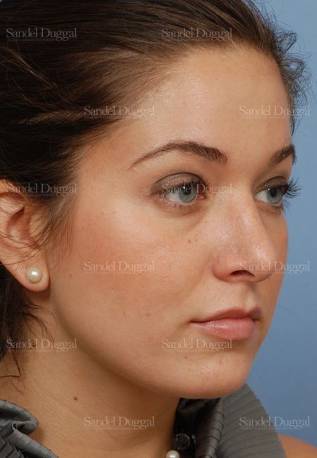 Rhinoplasty after, case 2894