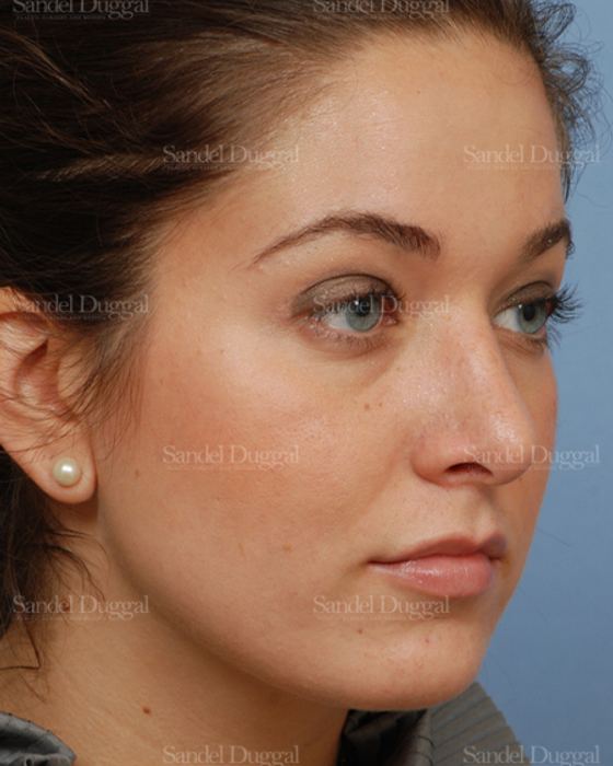 Rhinoplasty after, case 2894
