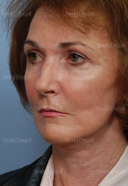 Cheek Augmentation after, case 1427