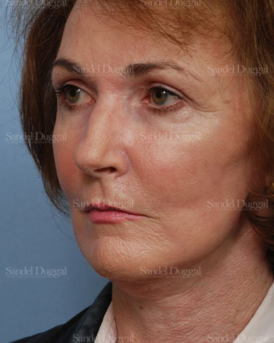 Cheek Augmentation after, case 1427