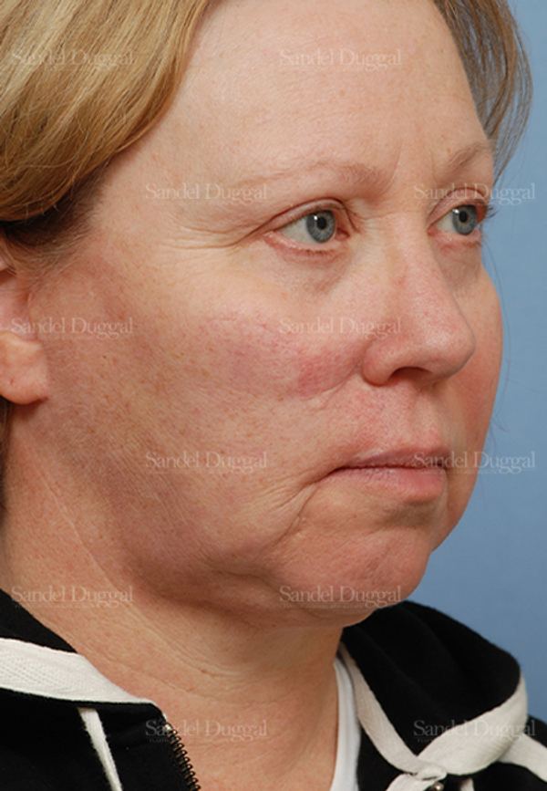 Reconstruction after Mohs after, case 2772