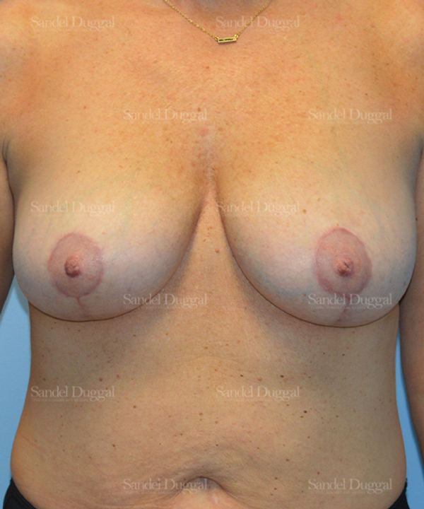 Breast Augmentation with Lift after, case 3442